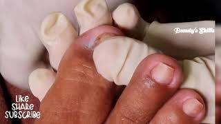 Very thick dry skin on the toenail/Satisfying client(Part2) | Beauty's Skills