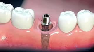 Have missing teeth? You should get an implant. Watch!