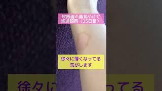 やけどの経過観察35日目「1ヶ月経ちました」（炊飯器の蒸気）湿潤療法/ワセリン/水ぶくれ/火傷/自然治癒