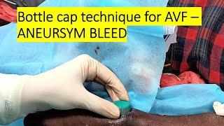 DIALYSIS AVF BLEED - BOTTLE CAP TECHNIQUE / VIDEO 226 (ARTERIOVENOUS FISTULA)