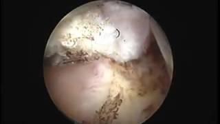Hystroscopic myomectomy G0
