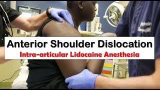 Anterior Shoulder Dislocation and Anesthesia with Intra-articular Lidocaine