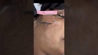 Permanent hair reduction 