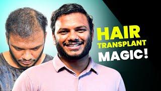 3500 Grafts, 6 Months, Amazing Results!  | Hair Transplant in Hyderabad | New Roots