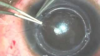 Intacs Insertion for Keratoconus