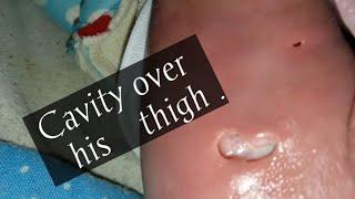 A Cavity over back of Thigh ‼️ || pus || Abscess || #whatilearntoday