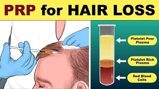 PRP Hair Treatment | prp hair loss treatment before and after | Hair loss Treatment