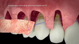 Múltiples recesiones gingivales adyacentes (Dr. Ion Zabalegui) - PerioPixel