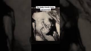 Funny fetus ultrasound #medicine #funny  #radiology #baby #fetus #pregnancy  #ultrasound #science