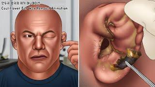 ASMR Very Old Cauliflower Massive Ear Wax Removal Animation | Ear Cleaning