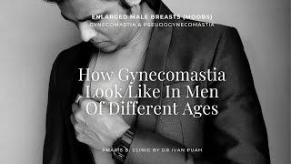 How Gynecomastia Look Like In Men Of Different Ages | Amaris B. Clinic by Dr Ivan Puah