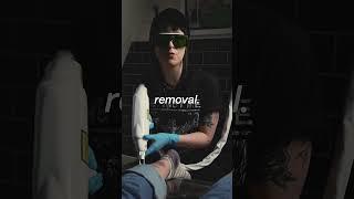 Save up to 40% off your laser removal with our unlimited packages. #lasertattoo #lasertattooremoval