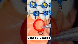 Dental Braces , Mini Screw TADs