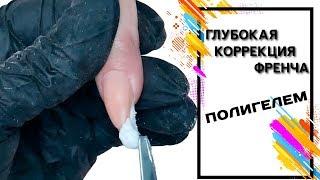 Глубокая коррекция френча Полигелем