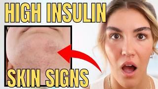 8 Signs Your Insulin Levels Are Too High (Why You Can’t Lose Weight!)