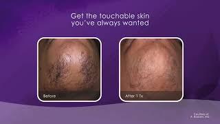 Cynosure Laser Hair Removal - Skin Perfection London