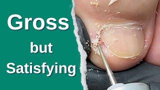 No More Pain – Ingrown Nail Finally Fixed