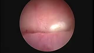 Hystroscopic tubal occlusion for hydrosalpinx