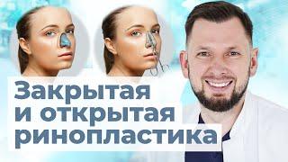 Открытая или закрытая ринопластика? Какой метод пластики носа лучше?