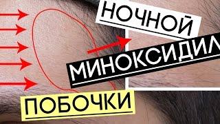 РИСКИ ПРИМЕНЕНИЯ МИНОКСИДИЛА ДЛЯ БОРОДЫ ПЕРЕД СНОМ