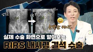 어떻게 내시경 수술로 결석을 해결할까? 실제 수술 화면을 통해 알아보는 RIRS 내시경 결석 수술!