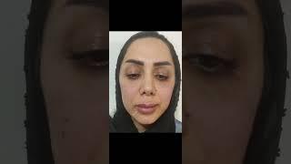 فيلر گونه و لب lip filler and face contouring #ژل_لب #ژل_گونه #lipfiller #facecontouring #beauty