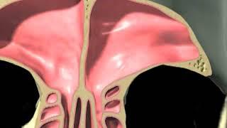 Balloon Sinuplasty and FESS Animation