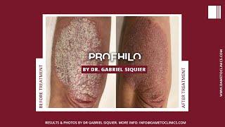 Profhilo and Psoriasis by Dr Gabriel Siquier