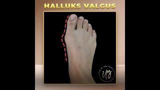 HALLUKS VALGUS  /  PROF  DR  UMUT YAVUZ