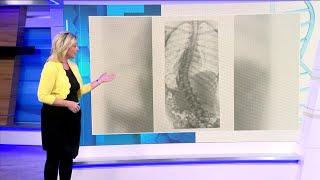 Talking scoliosis diagnoses, treatments with a pediatric orthopedic doctor