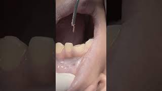 Tooth nerve #dentist