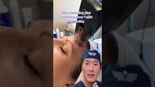 A New Way To Tighten Skin- Morpheus Radiofrequency Microneedling #shorts #morpheus