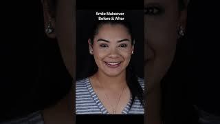small teeth corrected with porcelain veneers