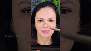 Aquela melhoradinha incrível pelo Dr Renato Maggio, harmonização facial.