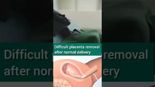 Placenta removal after normal delivery #pregnancy #normaldelivery#newborn #shortsfeed