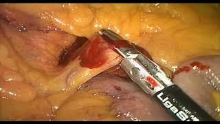 Intraoperative complications in laparoscopic colorectal surgery and how to avoid them