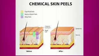 Chemical Peel: Purpose & Types