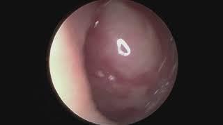 Paediatric Left Nasal Tumor