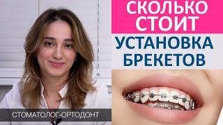 Сколько стоит установить брекеты. Стоимость установки металлических и керамических брекетов.