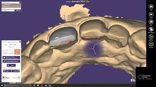 DOCTOR CAD - EXOCAD BASICS - HOW TO DESIGN TWO VENEERS WITHIN 10 MINUTES ON EXOCAD