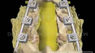 Lumbar Spine Pedicle Screw Fixation Fusion lawyer 3D animations