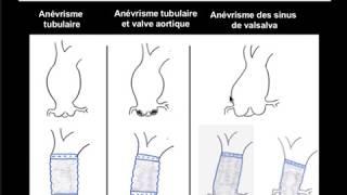 Votre opération du coeur: le remplacement de l'aorte ascendante lorsqu'on est porteur d'un anévrisme