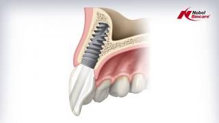 Angulated Screw Channel (ASC) Abutment