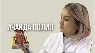 ПОЛИП ИЧАКДА аниқланди | даволаш, операция