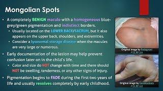 Congenital Dermal Melanosis (Mongolian Spots)