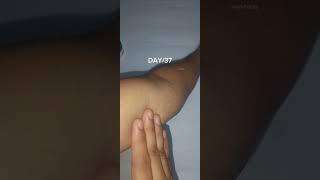 Day/37 of removing strech marks!