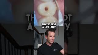 Small Spot turns into a Monster #shorts #dentalcavity #dentist