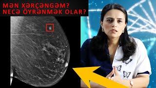 DİQQƏT! Döşünüzdə Bunu Hiss Edirsinizsə...-XƏRÇƏNGİN ƏLAMƏTİ