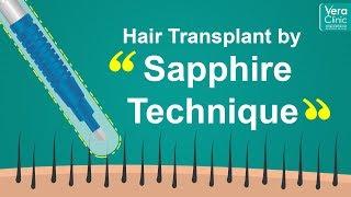 Hair Transplant by Sapphire Technique