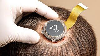 How These 5 Innovations Make Neuralink Possible